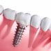 dental implants in India