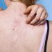 7 Powerful Home Remedies for Acne on the Back