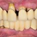Periodontitis - Symptoms, Risk factors, Home Remedies, Treatment, Causes